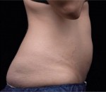 Liposonix® Before and after photo