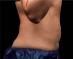 Liposonix® Before and after photo