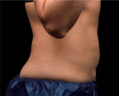 Liposonix® before and after photo