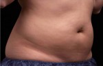 Liposonix® Before and after photo