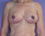 Nipple - Areola Correction Before and after photo