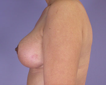 Nipple - Areola Correction before and after photo