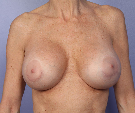 Nipple - Areola Correction before and after photo