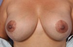 Nipple - Areola Correction Before and after photo