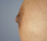 Nipple - Areola Correction Before and after photo