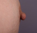 Nipple - Areola Correction Before and after photo