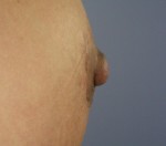 Nipple - Areola Correction Before and after photo