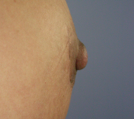 Nipple - Areola Correction before and after photo