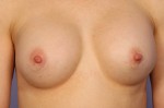 Nipple - Areola Correction