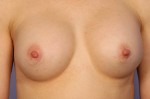 Nipple - Areola Correction Before and after photo