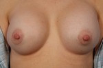 Nipple - Areola Correction Before and after photo