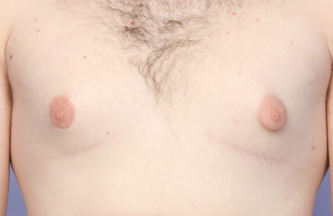 Nipple - Areola Correction before and after photo