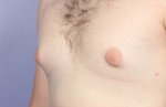 Nipple - Areola Correction Before and after photo