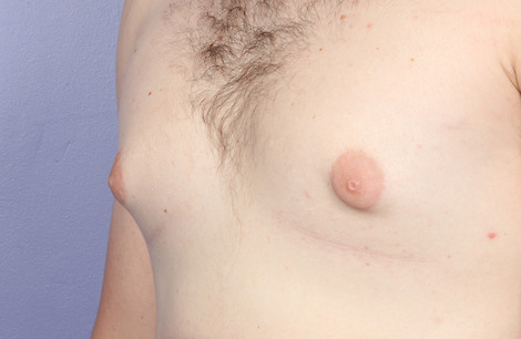 Nipple - Areola Correction before and after photo