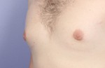 Nipple - Areola Correction Before and after photo