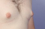 Nipple - Areola Correction Before and after photo