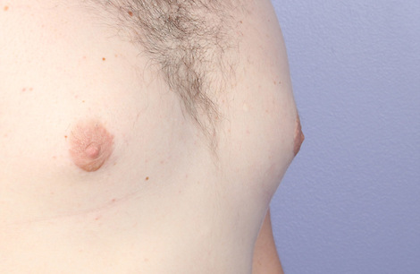 Nipple - Areola Correction before and after photo