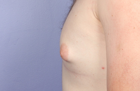 Nipple - Areola Correction before and after photo