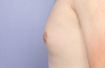 Nipple - Areola Correction Before and after photo