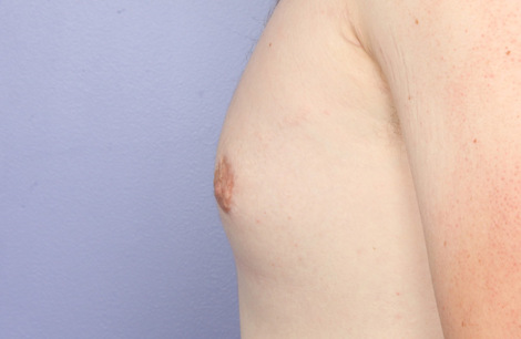 Nipple - Areola Correction before and after photo