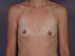 Breast Augmentation Before and after photo