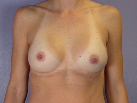 Breast Augmentation before and after photo