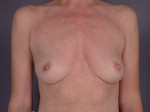 Breast Augmentation Before and after photo