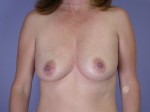 Breast Augmentation Before and after photo