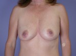 Breast Augmentation