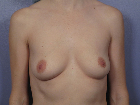 Breast Augmentation before and after photo