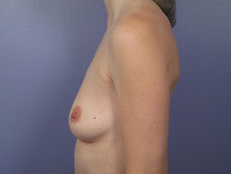 Breast Augmentation before and after photo