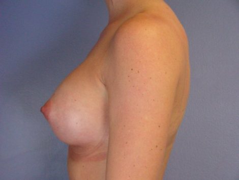 Breast Augmentation before and after photo