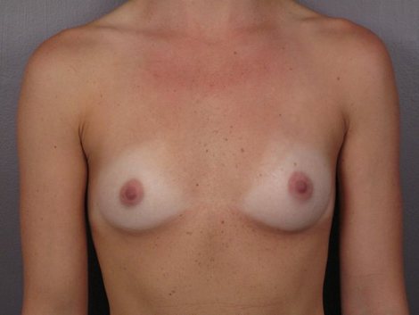 Breast Augmentation before and after photo