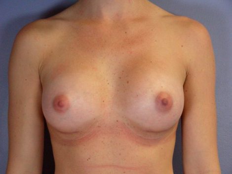 Breast Augmentation before and after photo