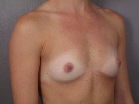 Breast Augmentation before and after photo