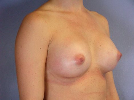 Breast Augmentation before and after photo