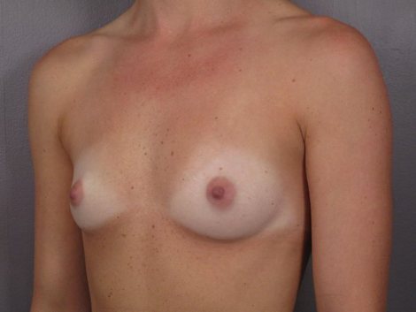 Breast Augmentation before and after photo