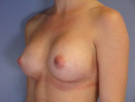 Breast Augmentation before and after photo