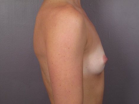 Breast Augmentation before and after photo