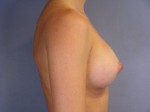 Breast Augmentation Before and after photo