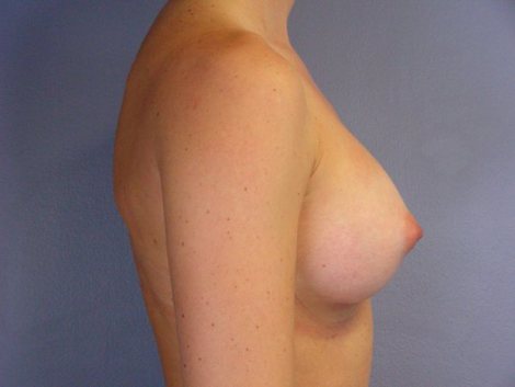 Breast Augmentation before and after photo