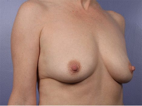 Breast Augmentation before and after photo