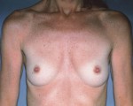 Breast Augmentation Before and after photo