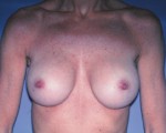 Breast Augmentation Before and after photo