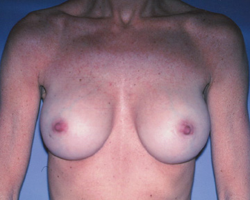 Breast Augmentation before and after photo