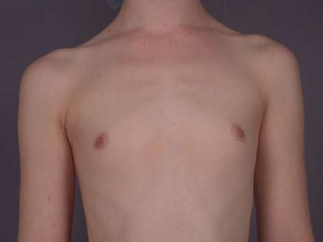 Breast Augmentation before and after photo