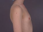 Breast Augmentation Before and after photo