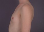 Breast Augmentation Before and after photo