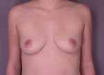 Breast Augmentation Before and after photo