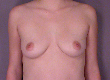 Breast Augmentation before and after photo